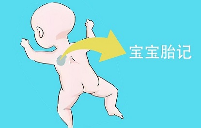 <strong>如何避免孩子长胎记？南京胎记医院哪里好一点？</strong>