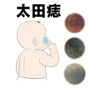 <strong>太田痣激光一次多少钱？江苏有几家正规的胎记医院？</strong>