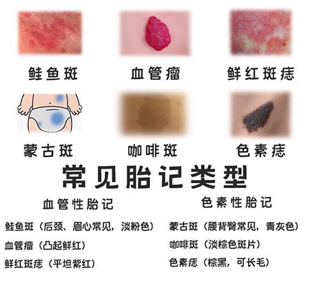 <strong>宝宝胎记如何护理？日常需要注意什么？</strong>