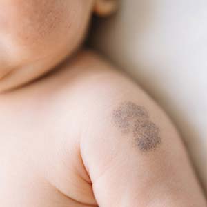 <strong>皮肤常识：宝宝胎记是怎么形成的？和孕期有关吗？</strong>