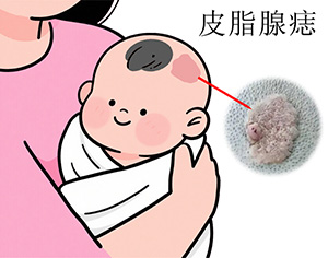 <strong>皮肤健康丨皮脂腺痣治疗费用多少？按大小收费吗？</strong>