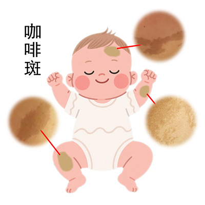 <strong>【健康须知】咖啡斑会随着年龄增长变大吗？影响健康吗？</strong>