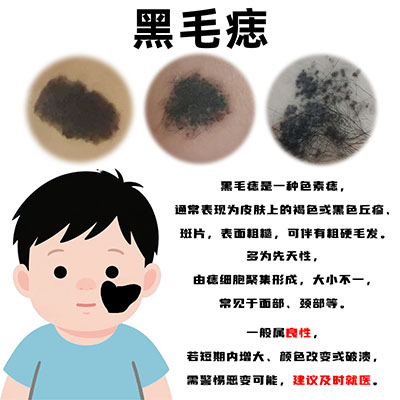 <strong>成人黑毛痣多年无变化，突然发痒需要切除吗？</strong>