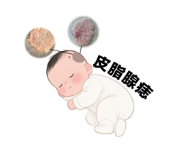 <strong>家长必看：皮脂腺痣会随着年龄长大吗？青春期会变厚吗？</strong>