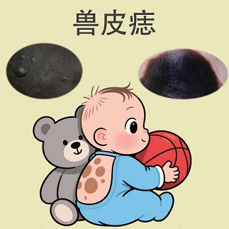 <strong>健康科普·兽皮痣切除后会复发吗？还会长出新的吗？</strong>