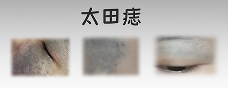 <strong>【胎记常识】太田痣治疗后多久能碰水？恢复期饮食有啥禁忌？</strong>