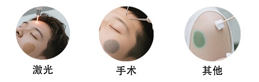 <strong>健康常识：宝宝胎记怎么治？激光、手术怎么选？</strong>