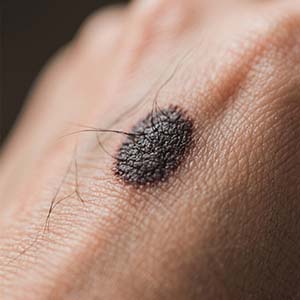 <strong>健康指南丨黑毛痣治疗费用大概多少？不同方法对比</strong>