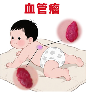 <strong>宝宝皮肤上突然鼓起红色包块？像小草莓，可能是血管瘤</strong>