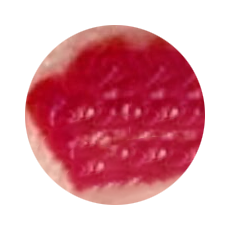 <strong>婴儿血管瘤什么时候治疗更好？错过时机后悔晚了！</strong>