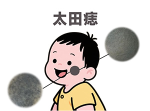 <strong>话题热议-这种青斑越长越深？警惕太田痣恶化！</strong>