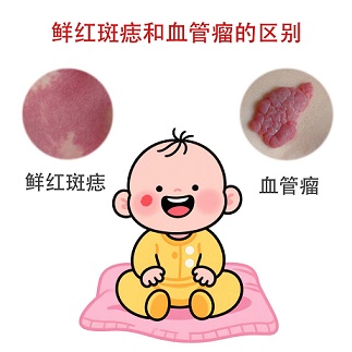 <strong>【误区纠正】鲜红斑痣是血管瘤吗？别搞混了！</strong>