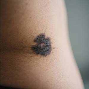 <strong>【费用查询】黑毛痣治疗需要多少钱？大小影响费用吗？</strong>