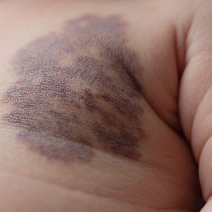 <strong>速报：孩子的胎记多大治疗合适？影响治疗效果吗？</strong>