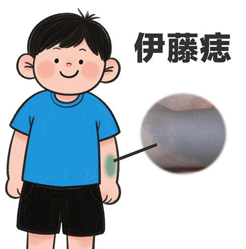 <strong>【健康疑问】伊藤痣会恶变吗？出现这些情况要检查！</strong>