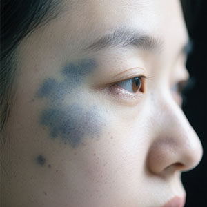 <strong>【防晒护理】治疗太田痣期间能晒太阳吗？防晒怎么做？</strong>