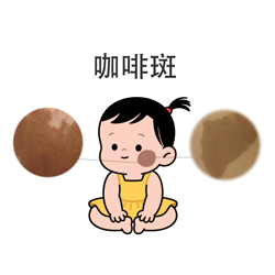 <strong>【专家解读】咖啡斑会恶变吗？什么情况下要警惕？</strong>