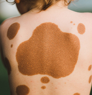 <strong>【费用因素】咖啡斑治疗费用多少？看类型和方法...</strong>