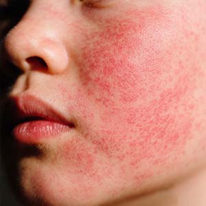 <strong>【健康认知】鲜红斑痣对身体有什么影响？不止影响外观...</strong>