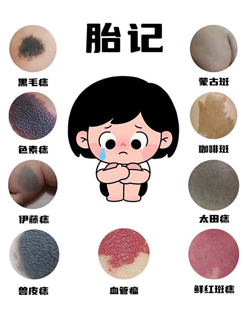 胎记随年龄一起长大，这种情况非管不可吗？