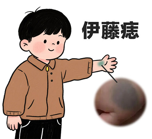 伊藤痣会随年龄扩大吗？南京哪家胎记医院靠谱？