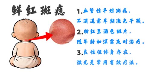 鲜红斑痣长期存在有哪些隐患？会不会影响身体健康？