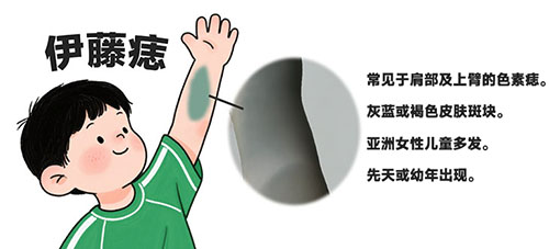 伊藤痣好对付吗？南京胎记机构的科学解读