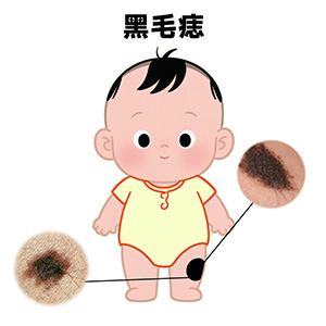 南京治疗胎记医院“新闻速递”胎记是怎么形成的？